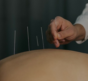 Acupuncture
